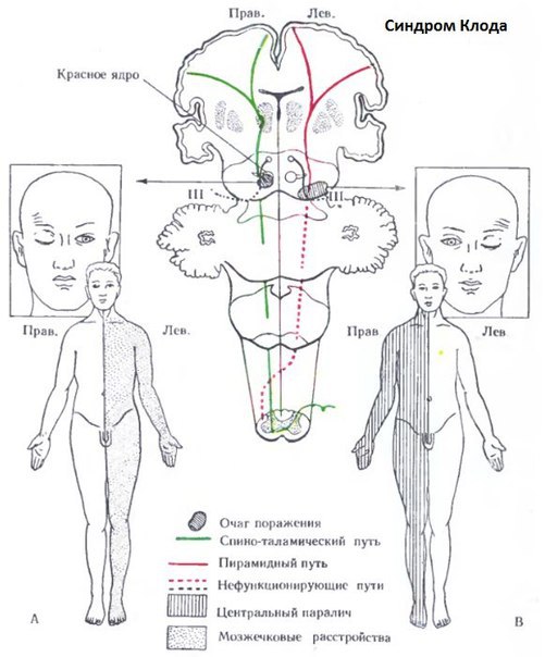 Альтернирующие синдромы в неврологии 