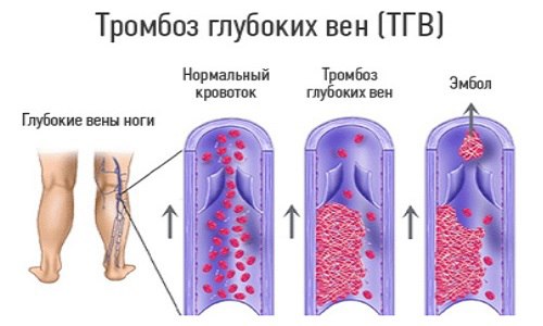 Венозные тромбозы - принципы терапии 