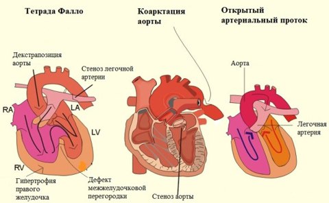 Врождённые пороки сердца – это все пороки клапанов сердца и перегородок сердца, возникшие в утробе матери ещё до появления младенца на свет. К классическим порокам сердца также относится врождённое поражение коронарных сосудов. Частота врождённых пороков сердца довольно высока и встречается у 1 % всех новорождённых.