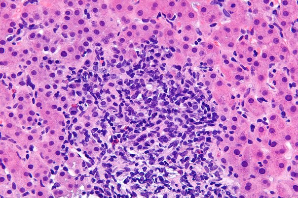 Аутоиммунный гепатит – это хроническое некротически-воспалительное заболевание печени неизвестной этиологии при котором главной мишенью иммунного ответа является гепатоцит и характеризующееся перипортальным или более обширным воспалительным процессом в печени, наличием гипергаммаглобулинемии и появлением широкого спектра аутоантител. Аутоиммунный гепатит – это хроническое некротически-воспалительное заболевание печени неизвестной этиологии при котором главной мишенью иммунного ответа является гепатоцит и характеризующееся перипортальным или более обширным воспалительным процессом в печени, наличием гипергаммаглобулинемии и появлением широкого спектра аутоантител.