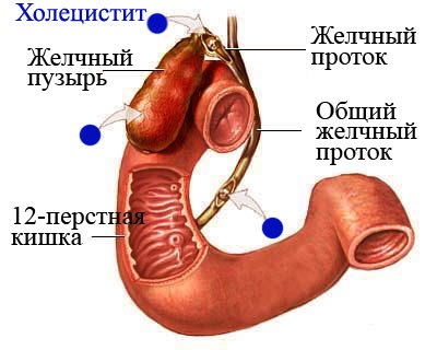 Хронический холецистит - хроническое рецидивирующее заболевание, характеризующееся воспалительными изменениями стенки желчного пузыря, преимущественно бактериального происхождения, приводящее к атрофии слизистой и склеротическим изменениям стромы, иногда возникающее вторично при дискинезии желчных путей и желчных камнях или паразитарных инвазиях. 