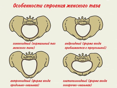 Анатомически и клинически узкий таз 