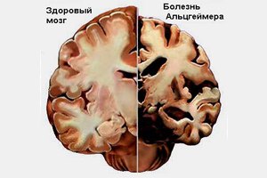 В крови нашли элемент, связанный с болезнью Альцгеймера