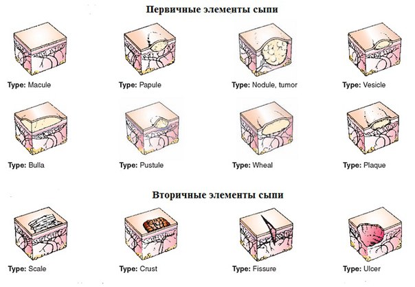 Узелок папула (papula) - ограниченное, слегка возвышающееся над уровнем кожи образование с плоской, куполообразной поверхностью. Появляется вследствие скопления воспалительного инфильтрата в верхних слоях дермы или разрастания эпидермиса. Окраска папул может быть различной. При слиянии между собой папулы образуют бляшки или целые площадки, занимающие целые участки кожи. После заживления могут оставлять временную пигментацию или депигментацию, шелушение кожи. 
