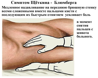 Симптом Щеткина-Блюмберга – симптом раздражения брюшины, является положительным, если при надавливании на живот возникает боль, которая резко усиливается при отдергивании руки пальпирующего. Считается одним из важнейших симптомов в экстренной хирургии. Положительный симптом Щеткина может говорить об остром процессе в животе, встречается при остром аппендиците, перитоните, некоторых других острых заболеваниях брюшной полости. 