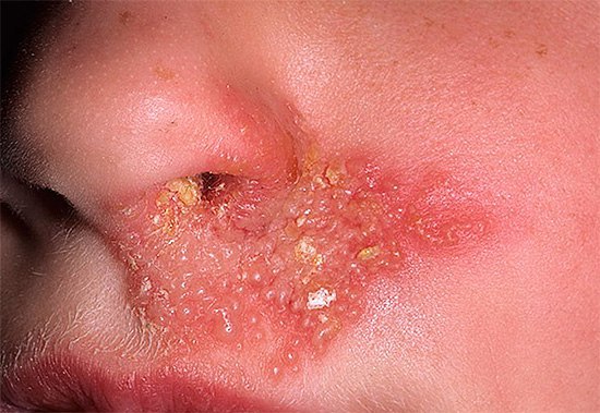 Народные средства, травы при герпесе. 