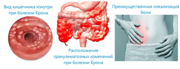 Болезнь Крона — хроническое рецидивирующее заболевание желудочно-кишечного тракта, характеризующееся неспецифическим гранулематозом и некрозом. 
