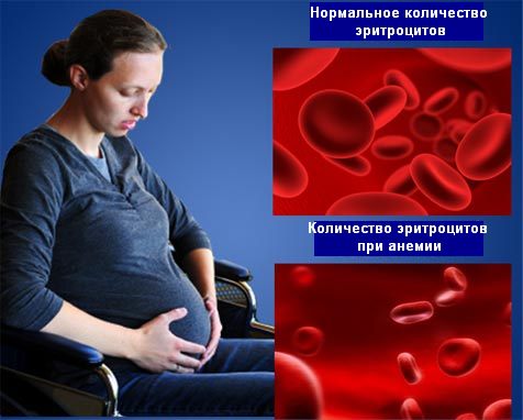 Анемия у беременных 