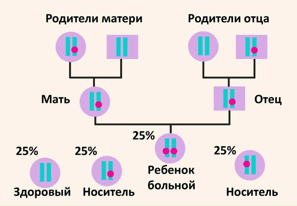 Галактоземия 