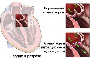 Синдромы инфенкционного эндокардита