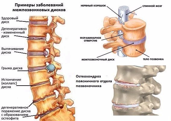 Побеждаем остеохондроз ! 