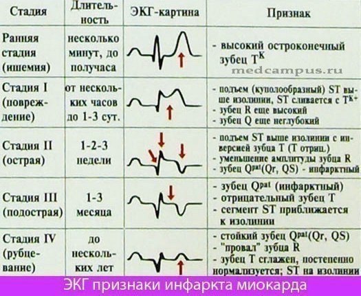 Стадии развития инфаркта миокарда