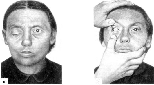 Симптомы поражения глазодвигательные нервы. 