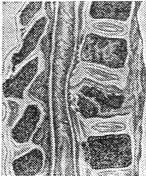 Спондилит — воспалительный процесс в позвоночнике. Чаще всего спондилит (почти в 95% случаев) имеет туберкулезную этиологию, значительно реже встречаются стафилококковый, сифилитический, послетифозный спондилит, актиномикоз позвоночника, хронический остеомиелит позвонков. 