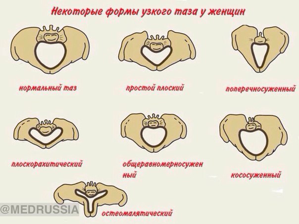 Анатомически узкий таз - это таз, в котором все размеры, или хотя бы один из них меньше нормальных на 1,5-2 см и более. 