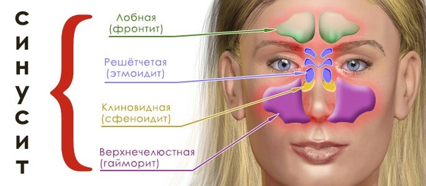 Как распознать синусит 
