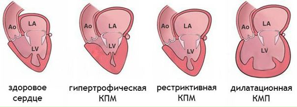 Классификация кардиомиопатий 