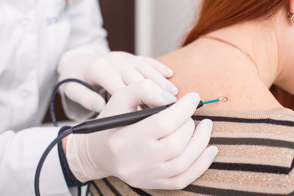 Чем опасны бородавки  