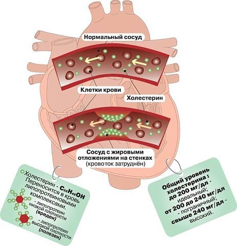ОЧИЩАЕМ СОСУДЫ ОТ ХОЛЕСТЕРИНА В ДОМАШНИХ УСЛОВИЯХ. 