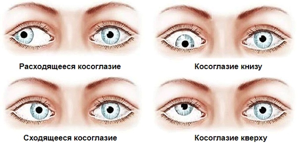 Косоглазие (strabismus) - отклонение (девиация) одного глаза от общей точки фиксации. 