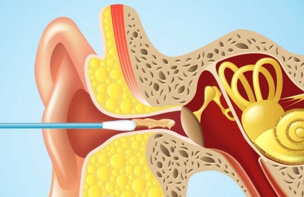 Чистить уши вредно 