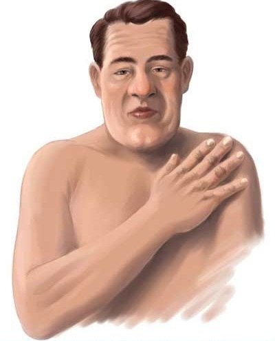 Акромегалия - заболевание, обусловленное избыточной продукцией соматотропина и характеризующееся диспропорциональным ростом костей скелета, мягких тканей и внутренних органов. 