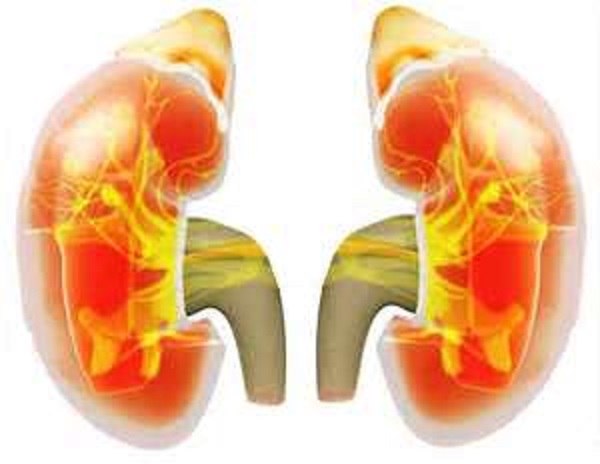 Нефротический синдром- клинико-лабораторный симптомокомплекс, включающий массивную протеинурию (5 г в сутки и более), нарушения белкового, липидного и водно-солевого обменов, а также отеки, вплоть до анасарки с водянкой серозных полостей. 