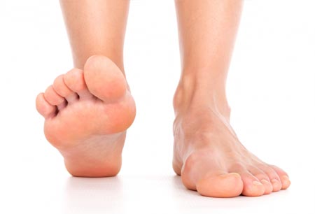 Плоскостопиe: причины, симптомы, лeчeниe. 