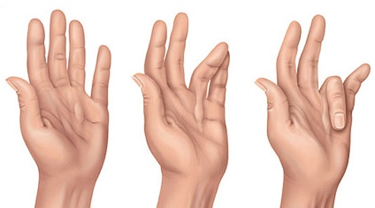 Ученые в шаге от победы над наследственным заболеванием