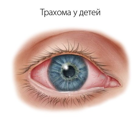 Трахома 