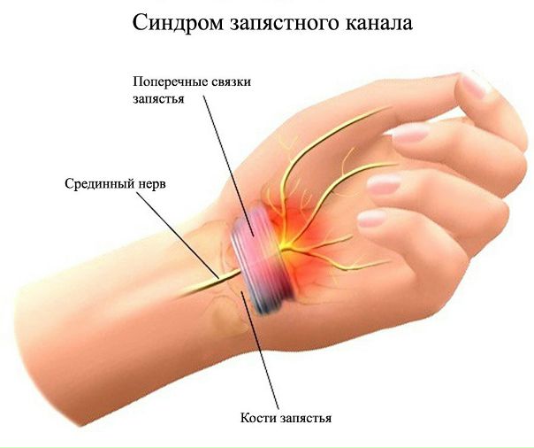 Синдром запястного канала (карпальный синдром). 