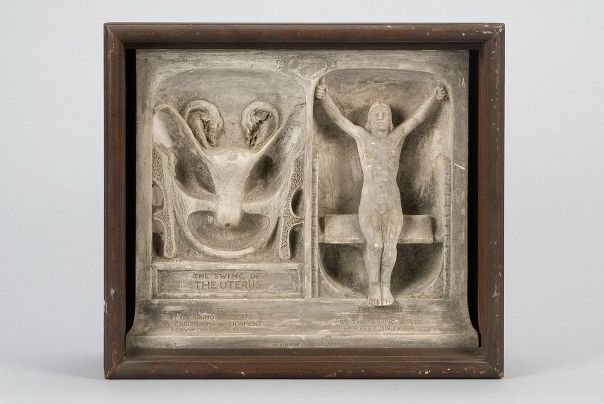 Американский акушер-гинеколог и по совместительству художник Роберт Дикинсон (Robert Latou Dickinson) долго думал, как бы объяснить студентам топографию матки, чтобы получилось просто, понятно и, главное, памятно. И однажды его посетила такая мысль: матка словно качается на качелях! Ведь связки матки делятся две группы: подвешивающий аппарат, довольно свободно связанный с дном и телом матки - совсем как качельные веревки, и закрепляющий аппарат, более жестко фиксирующий нижнюю часть тела и шейку матки - как доска. 