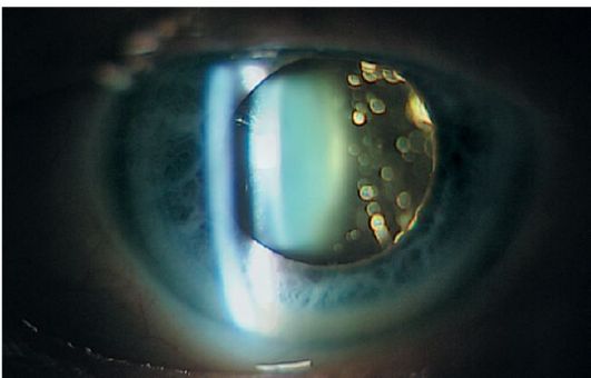 Деструкция стекловидного тела 