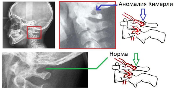 Аномалия Киммерле — аномальное костное кольцо вокруг позвоночной артерии в области задней дуги первого шейного позвонка. Оно приводит к ограничению подвижности как артерии, так и всего краниовертебрального сочленения. 