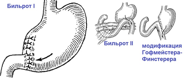 Резекция желудка. 