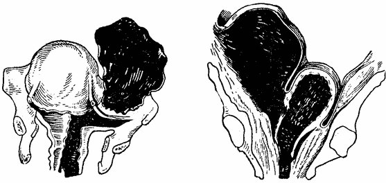 Разрыв матки - это одно из тяжелейших осложнений в акушерстве. 