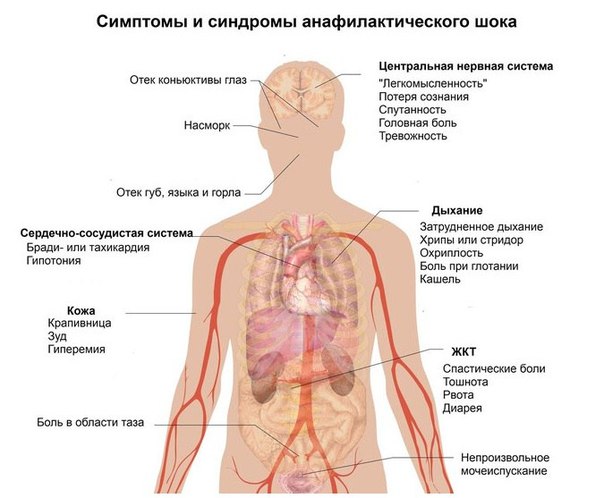 Анафилактический шок 