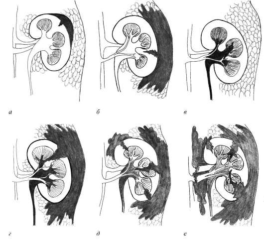 Классификация разрывов почки: 