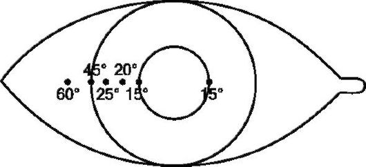 Косоглазие (strabismus) - отклонение (девиация) одного глаза от общей точки фиксации. 