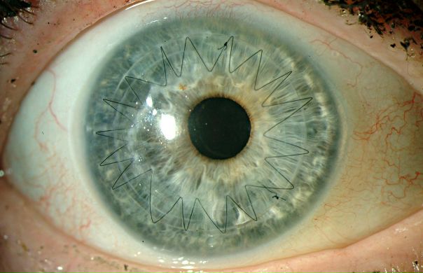 ХИРУРГИЧЕСКОЕ ЛЕЧЕНИЕ ЗАБОЛЕВАНИЙ РОГОВИЦЫ 