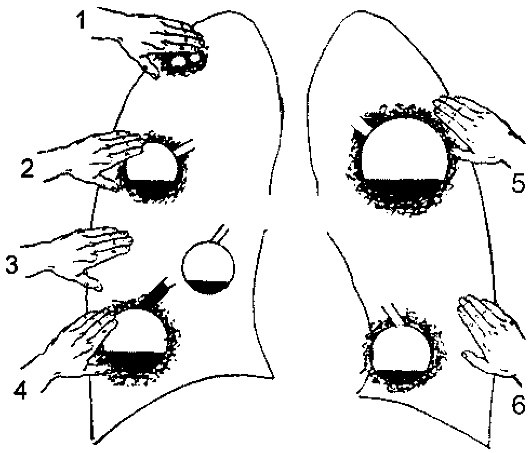 Варианты изменения голосового дрожания при наличии в легких полостных образований разной величины и глубины расположения. 