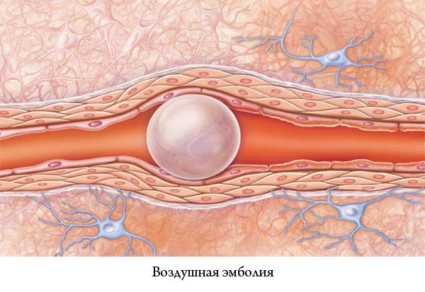 Эмболия - это закупорка сосудов эмболами, приносимыми током крови или лимфы. 