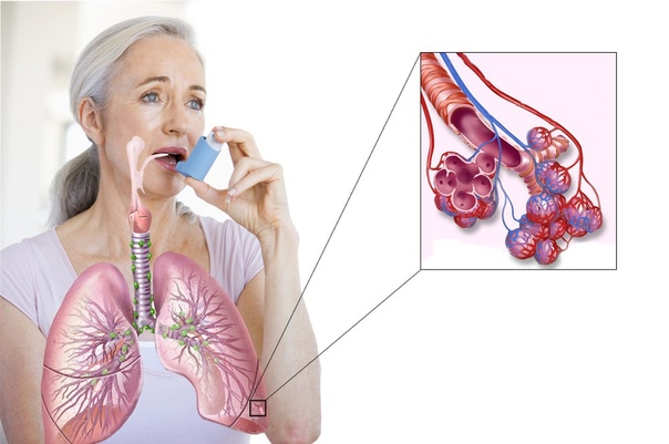Неотложная помощь при приступе бронхиальной астмы. 