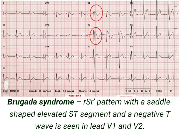 Синдром Бругада