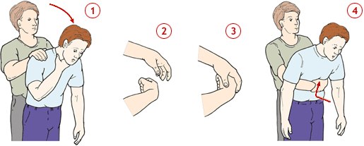 Что делать, если кто-то подавился 