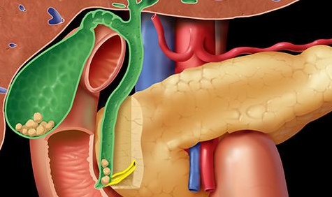 Диагностика холелитиаза 