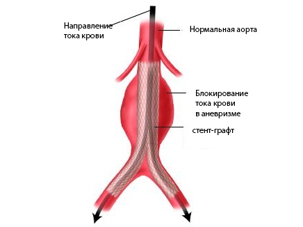 Транслюминальная имплантация стент-графт-протеза при аневризме аорты 