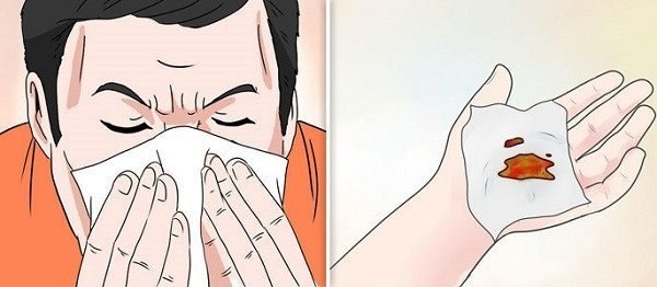 6 приемов, которые помогут быстро остановить кровотечение из носа. 