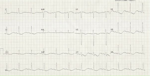 Хотите научиться анализировать подобные ЭКГшки