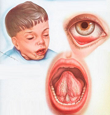 Коклюш - острая антропонозная бактериальная инфекция, сопровождающаяся катаральными изменениями в верхних дыхательных путях и приступообразным спазматическим кашлем.